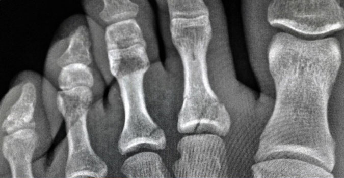 An x-ray of Kelly Slater's broken toes. Photo: @kellyslater Instagram