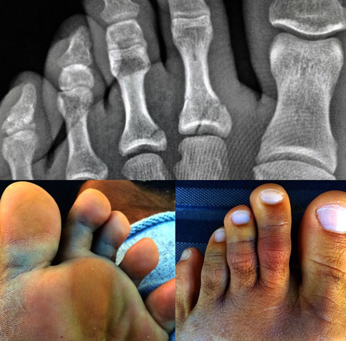 Kelly Slater's left foot has seen better days. But by December 8, Slater says this left foot will be healed up and leading him out of barrels at Pipe Masters. Photo: @kellyslater