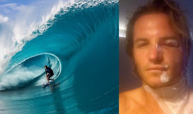 Laurie Towner injured at Teahupoo during Point Break filming.