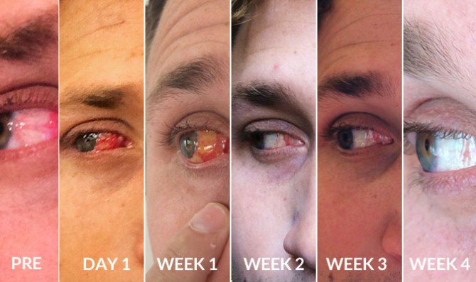 Four weeks and my eye was basically good as new. Pretty crazy.