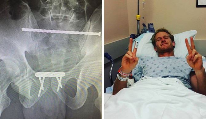 Surgeons inserted a 17 cm rod, a metal plate, and four screws to hold him together. Photos: Facebook