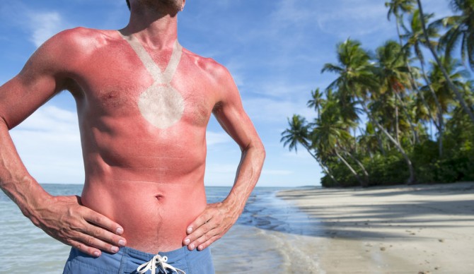 You should get an award for that sunburn. Wait. Photo: Shutterstock