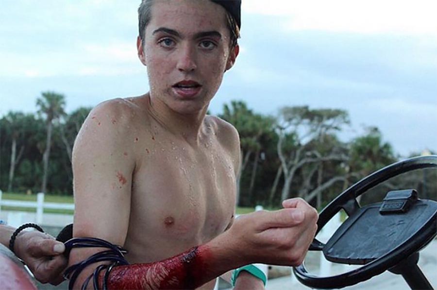 Teenager in Florida Bitten by Shark While Wearing a Deterrent Bracelet