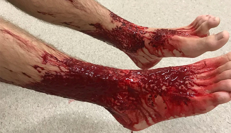 Sam Kazinay's legs came out of the water looking like this. Image: AAP