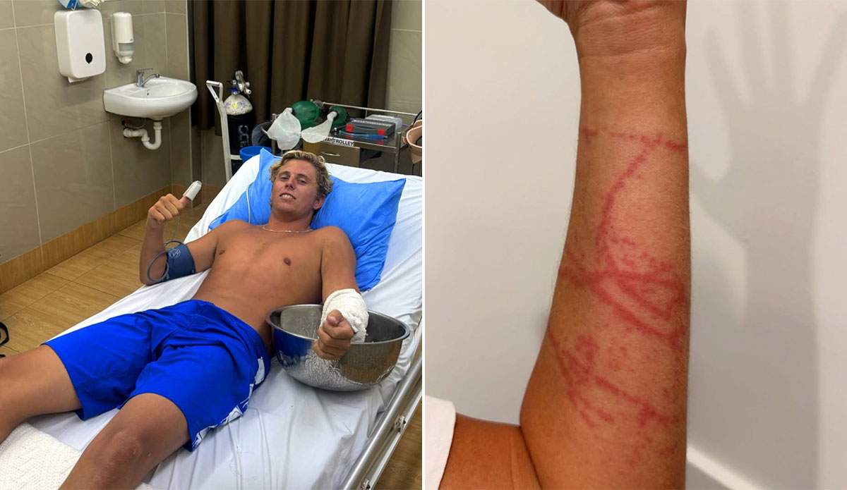 Australian Surfer Stung by Box Jellyfish at Cloudbreak Recounts Terrifying Ordeal
