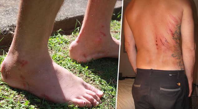 Surfer Reef cuts on skin