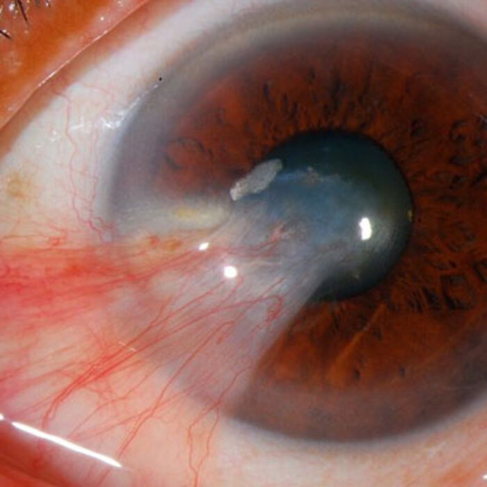 While I stand by my word – battle scars will never stop being cool – I've come to realize that maybe, just maybe, there are a few people that don't want the equivalent of a slug growing off of their eyeball.