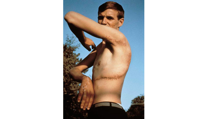 Rodney Fox, a few months after his attack in Australia. 