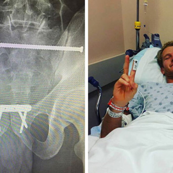 Surgeons inserted a 17 cm rod, a metal plate, and four screws to hold him together. Photos: Facebook