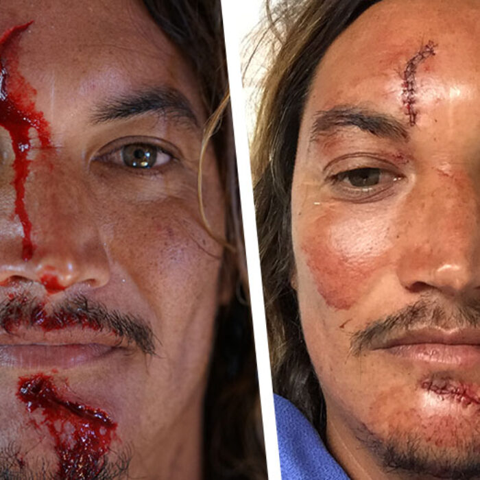 Mikala Jones Injured Stitches to Face at Off the Wall
