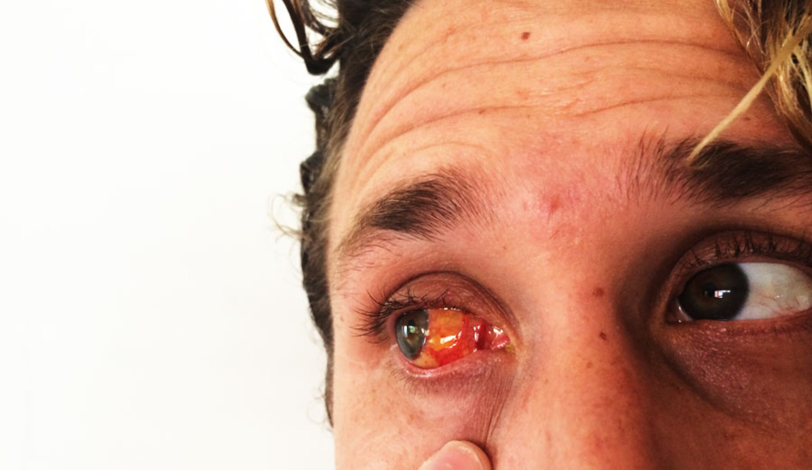 Zach Weisberg, post-surgery. 