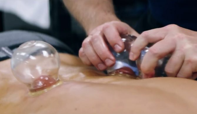 Michael Phelps uses cupping therapy. Should you?