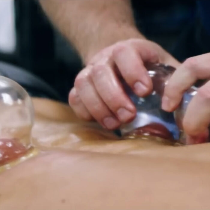 Michael Phelps uses cupping therapy. Should you?