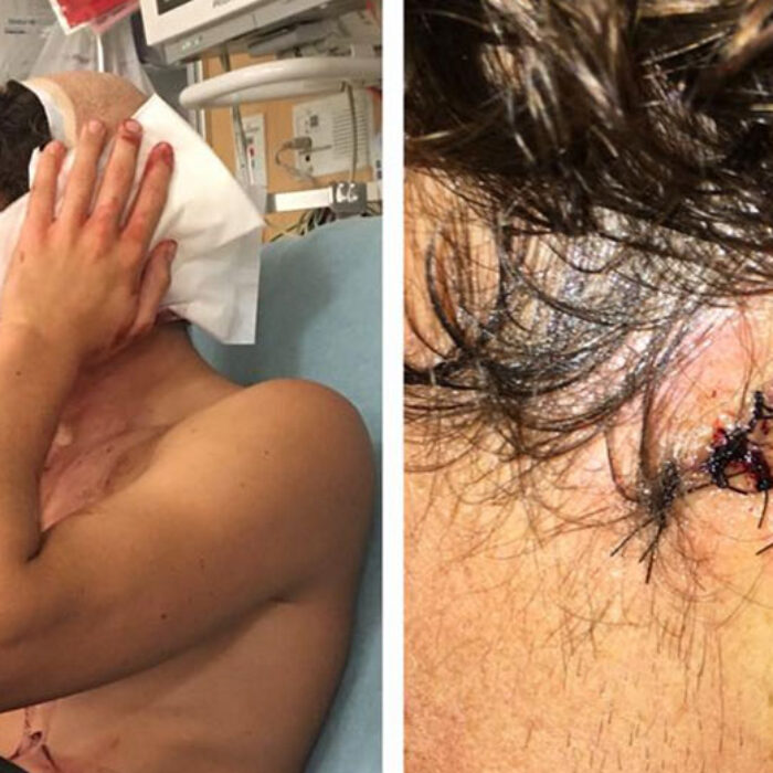 When Leonardo Fioravanti went for a morning surf at Huntington Beach before the Vans US Open of Surfing, he didn't expect to end it in the hospital.