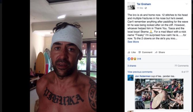 The injured surfer, on the mend after being run over. Photo: Facebook