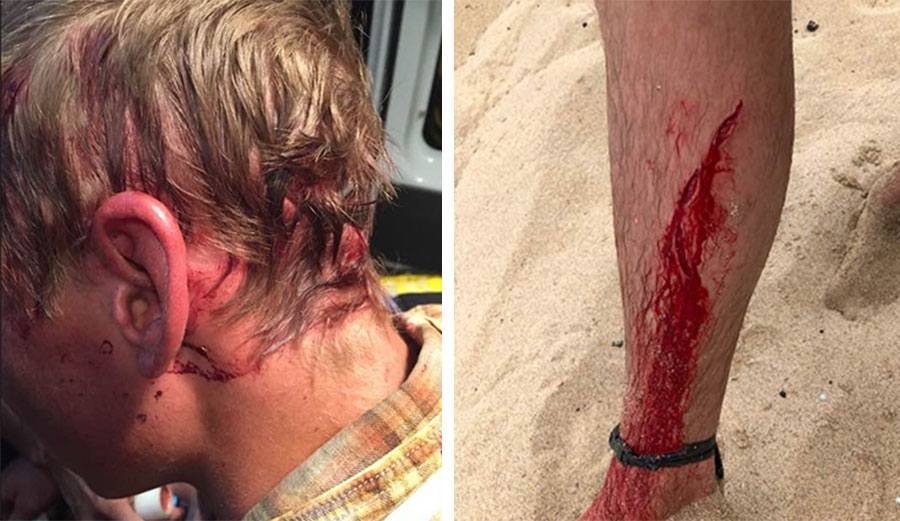 In July of 2017, McWilliams was dragged by his head across a campground by a bear. In April, a shark attacked him in Kauai. Images: McWilliams/Facebook