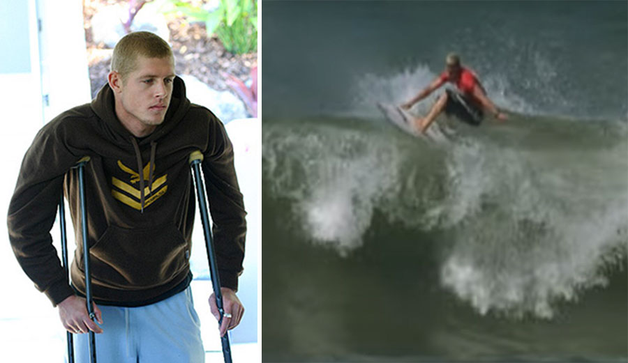 Mick Fanning tore his hamstring clean off the bone in 2004, very nearly ending his career.
