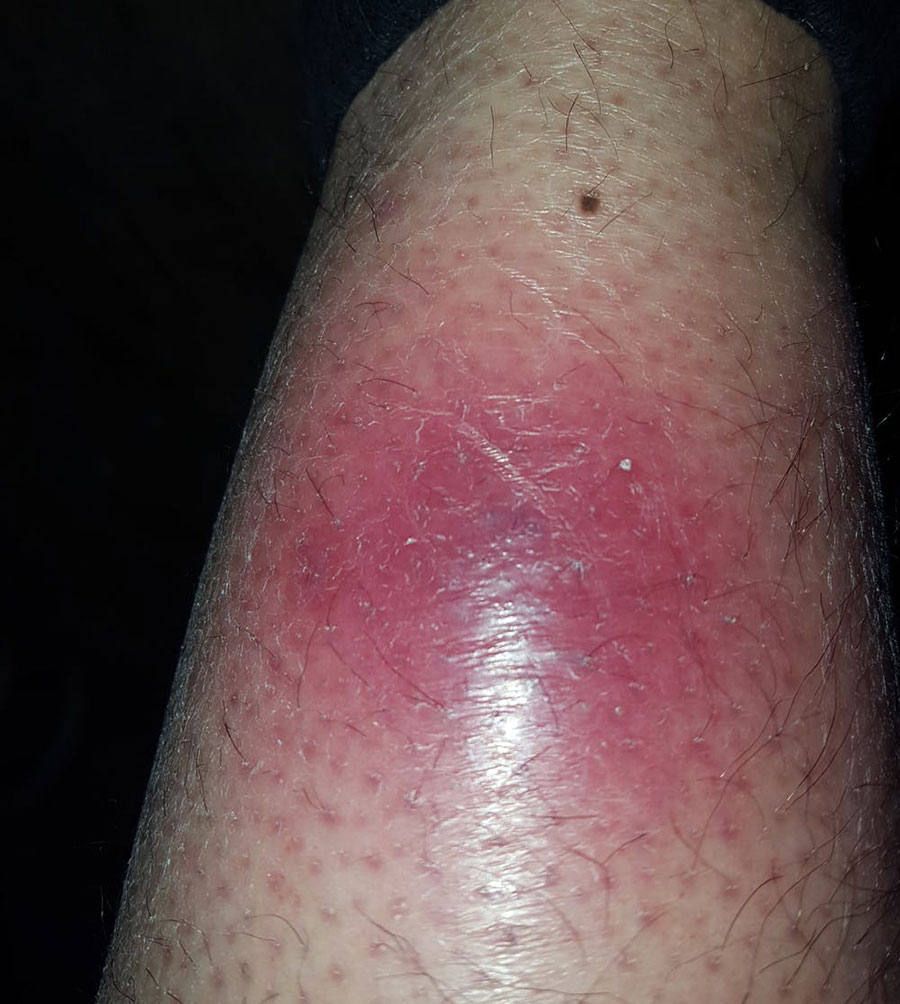 Flesh eating bacteria on leg