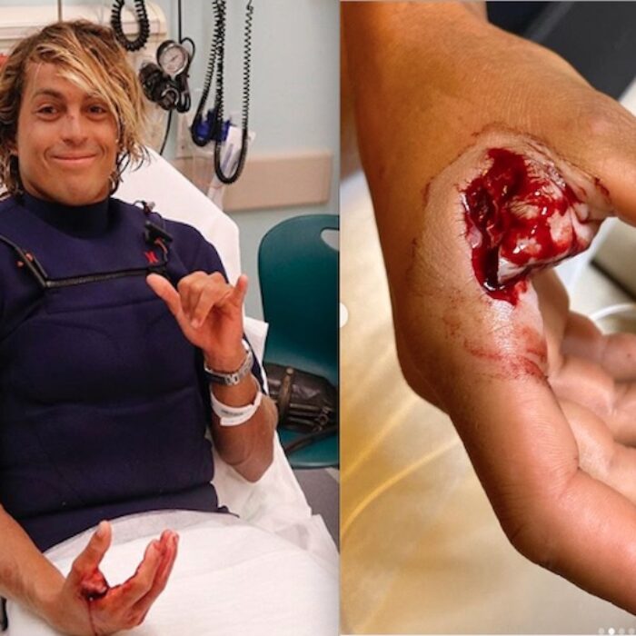 Big Wave Surfer Kai Lenny Mangles Injures Hand Following Accident at Jaws