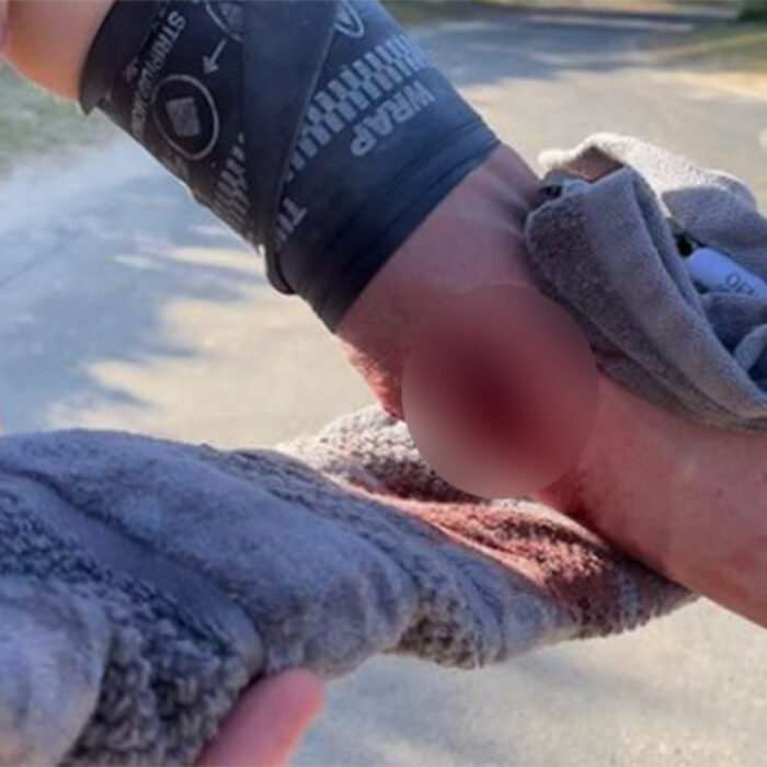 Russell Bierke's forearm cut
