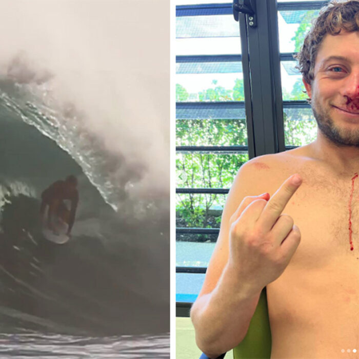 Parker Coffin Suffers Head Injury After Serious Wipeout in Barbados