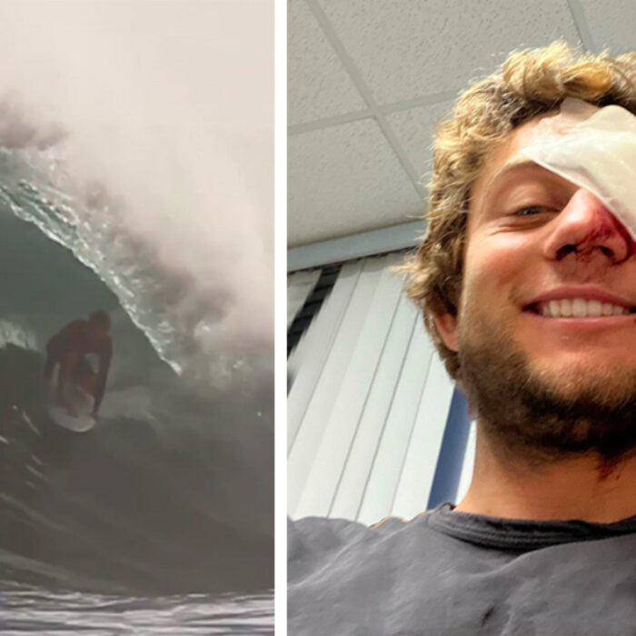 Parker Coffin Suffers Head Injury After Serious Wipeout in Barbados