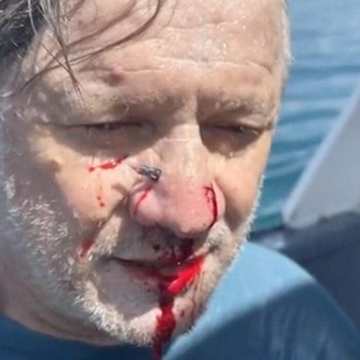 Man is impaled in the face by a garfish in the Mentawais.