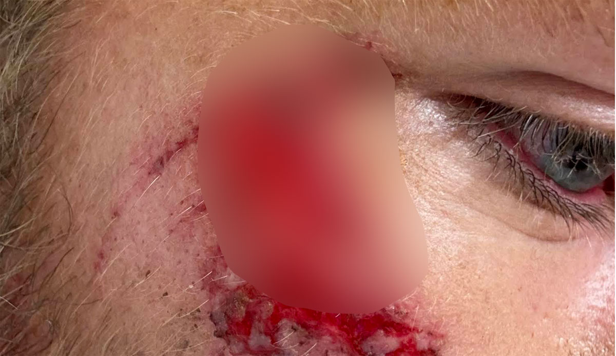 Nate Florence Left With 9 Stitches to the Face After Pipeline Wipeout - Vimarsana News