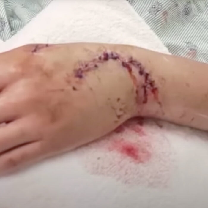 A teen suffered a shark bite while vacationing in Galveston. Photo: Fox 26 Houston // YouTube