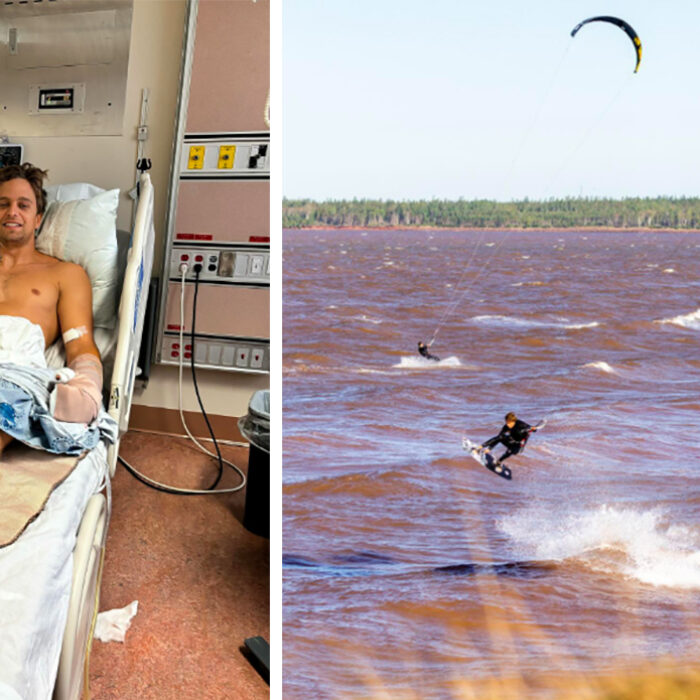 Canadian Kiteboarder in Recovery After Losing Leg in Caribbean Shark Attack