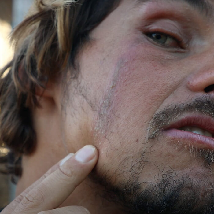 Nic Von Rupp shows off his latest injury at the hands of Indonesian wildlife. Photo: Nic Von Rupp // YouTube