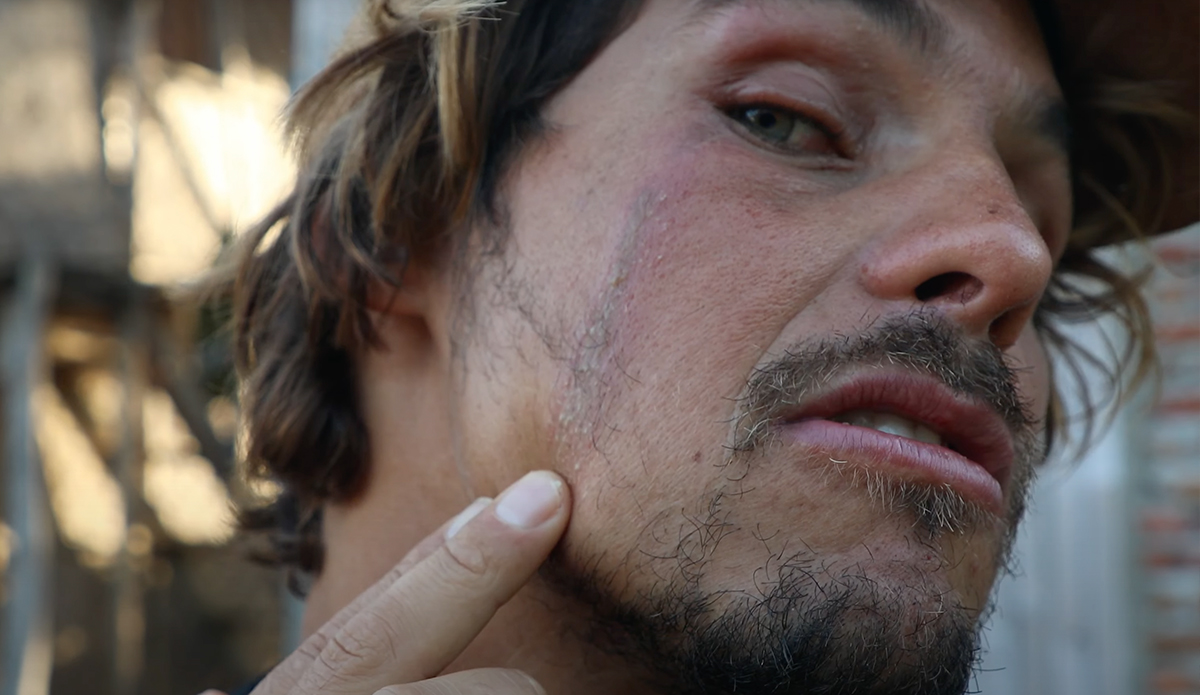 Nic Von Rupp shows off his latest injury at the hands of Indonesian wildlife. Photo: Nic Von Rupp // YouTube