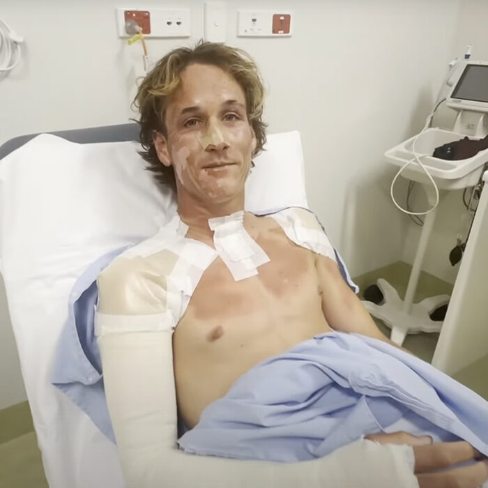 Jensen Kirby received burns to 13 percent of his body from an explosion that happened on an Indonesian surf trip. Photo: Jensen Kirby // YouTube