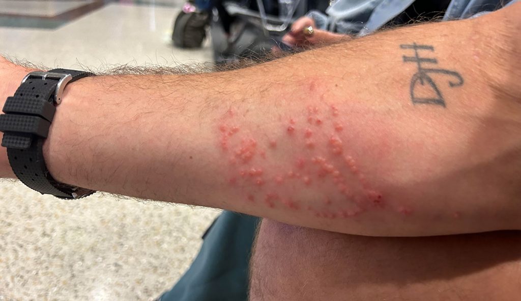 Jellyfish Sting Remedies Urine Vs. Vinegar on a Portuguese Man O' War