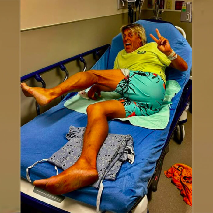 Florida Surfer Suffers Bull Shark Bite to Leg, Ending 148-Day Surf Streak
