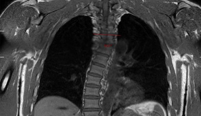 Kelly Slater scoliosis