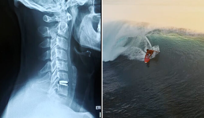 Soli Baily neck x-ray and surfing a wave in Indonesia
