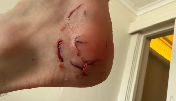 The size of the bites led authorities to estimate the shark was 5 to 7 feet long. Photo: ABC News // Oliver Tokic-Bensley