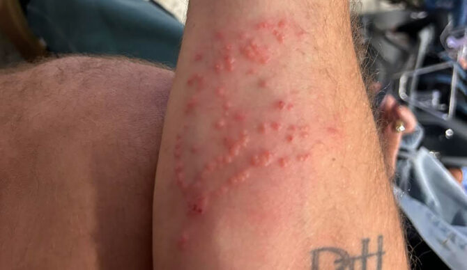 Jellyfish sting on arm