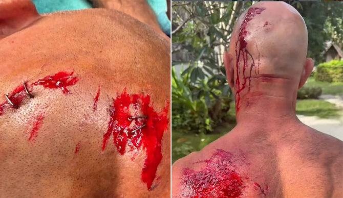 Shane Dorian injured surfing in Indonesia