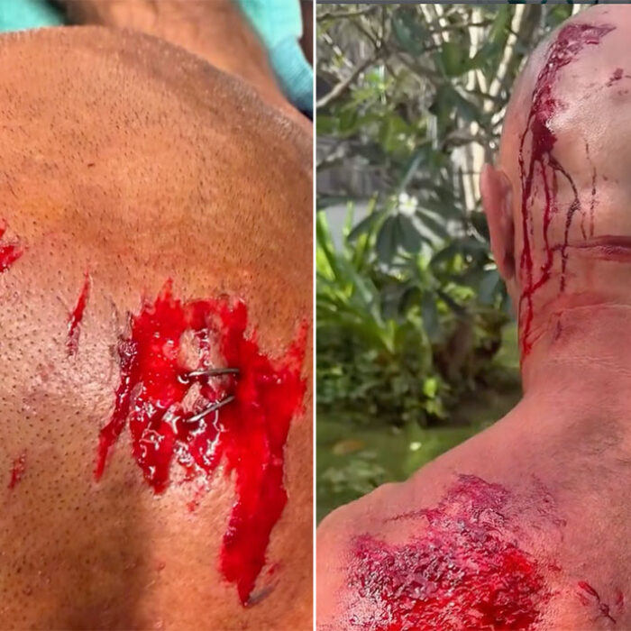 Shane Dorian injured surfing in Indonesia