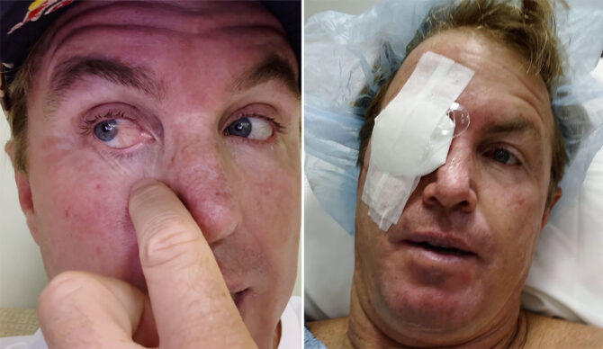 Jamie O'Brien before and after pterygium surgery