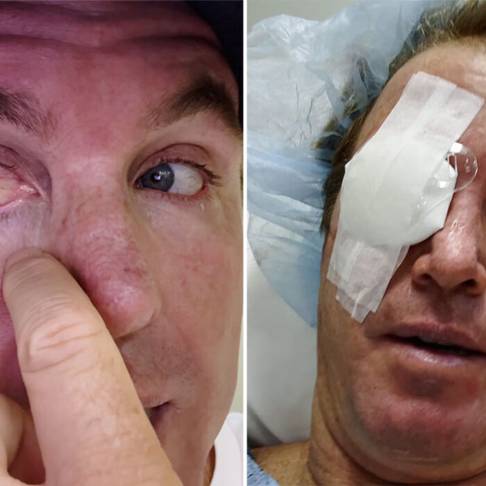Jamie O'Brien before and after pterygium surgery