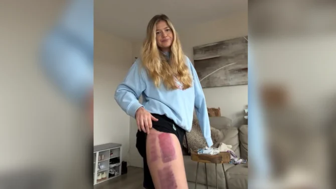 Stewart showed her recent skin grafts in a social media post. Photo: Leah Stewart // Instagram
